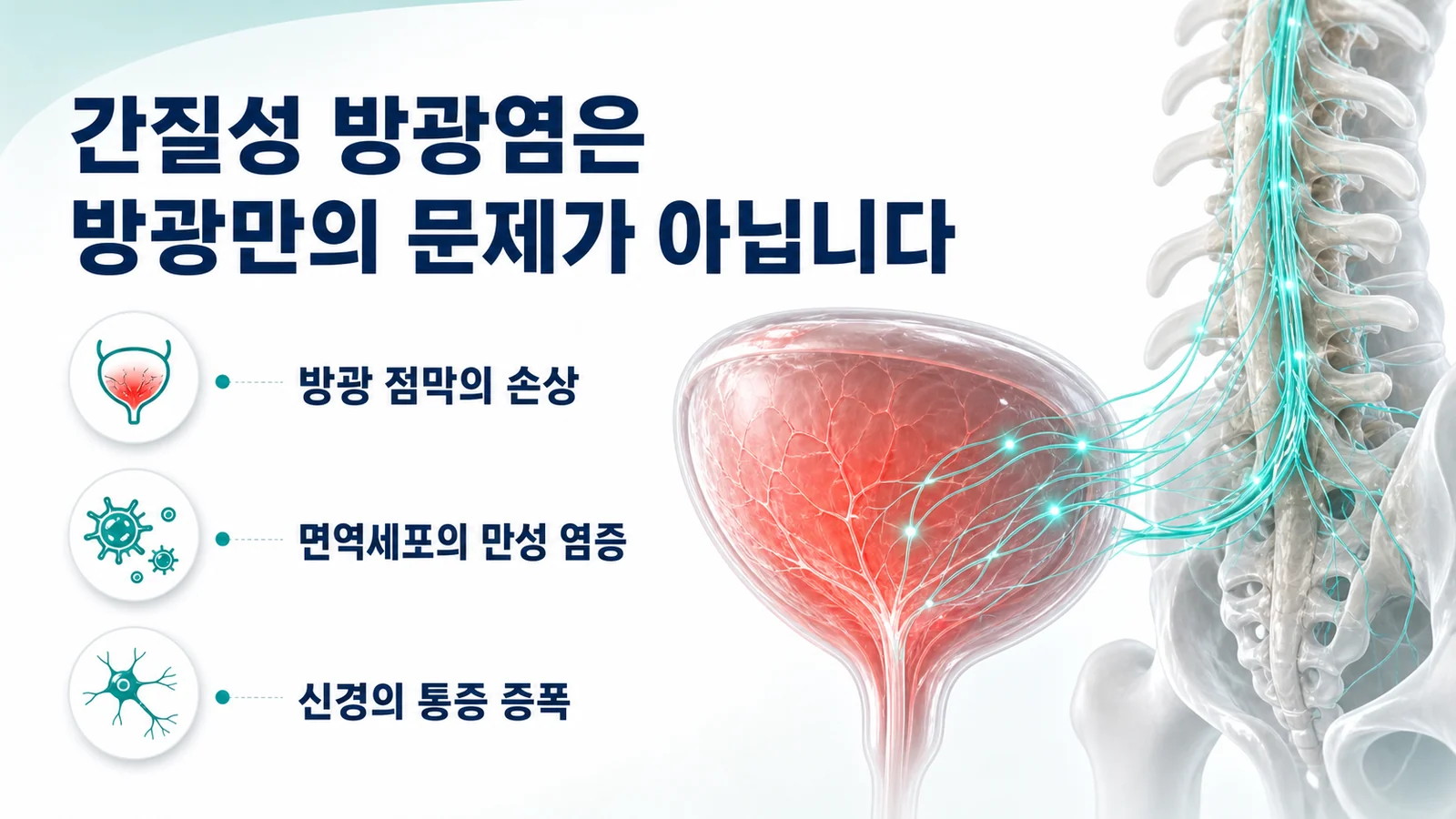 간질성 방광염이 방광만의 문제가 아니라는 것을 설명하는 그림. 방광에서 척수까지 이어지는 신경 경로와 함께 방광 점막의 손상, 면역세포의 만성 염증, 신경의 통증 증폭이라는 세 항목이 정리되어 있다