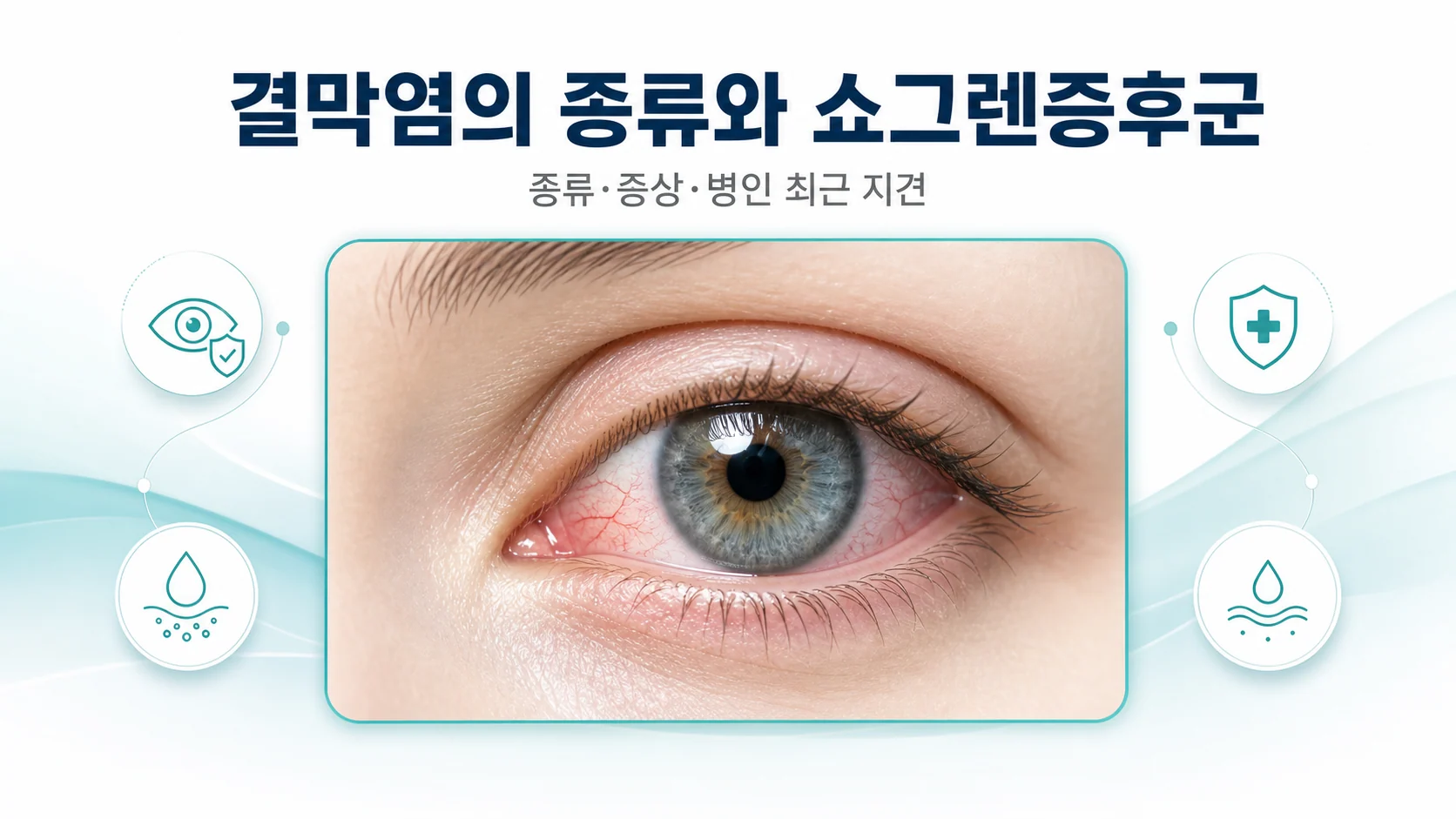결막염의 종류와 쇼그렌에 흔한 건성각결막염을 정리한 대표 이미지