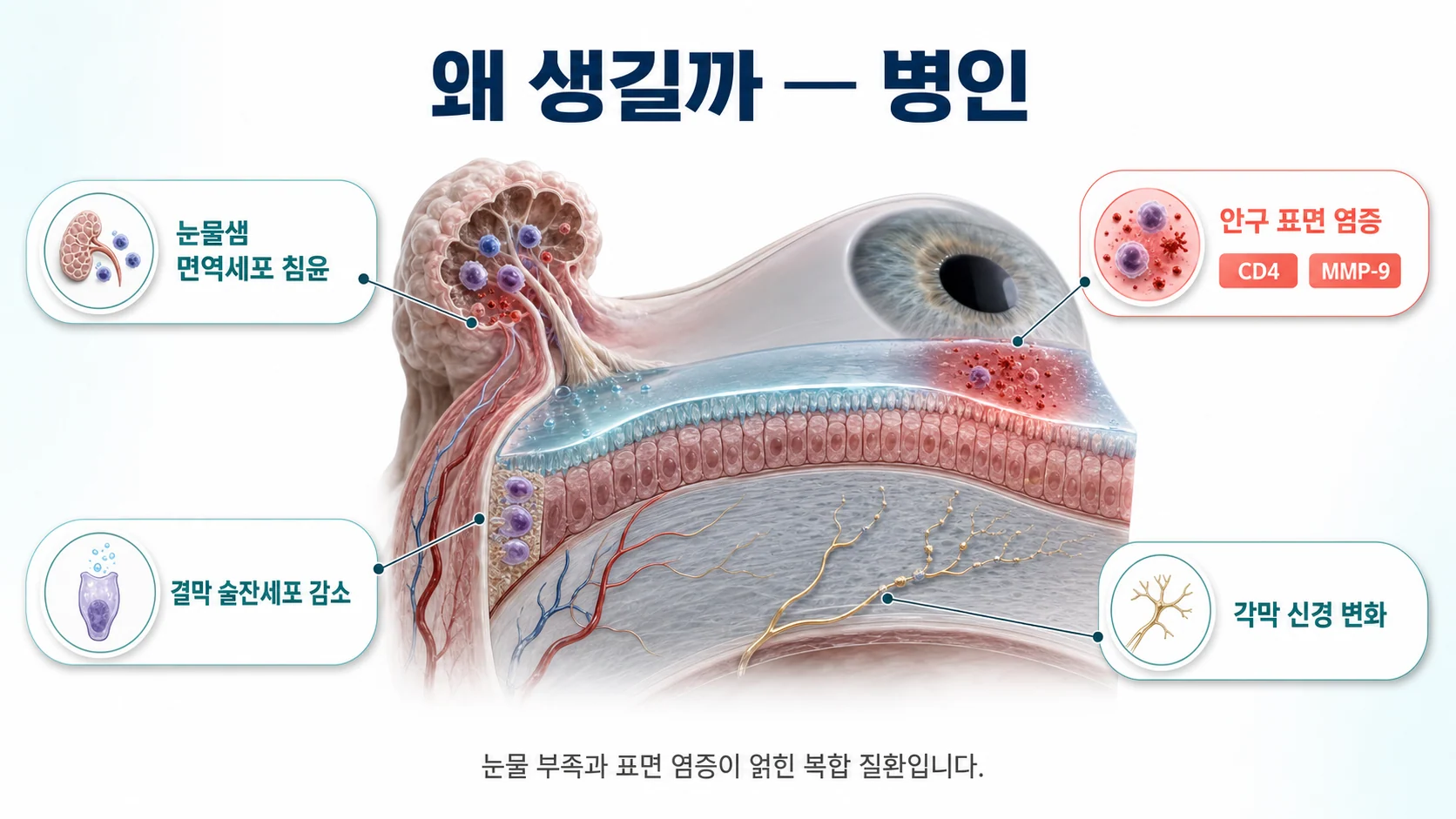 쇼그렌증후군 건성각결막염의 병인 — 눈물샘 면역세포 침윤 안구표면 염증 술잔세포 감소 각막신경 변화를 보여주는 이미지