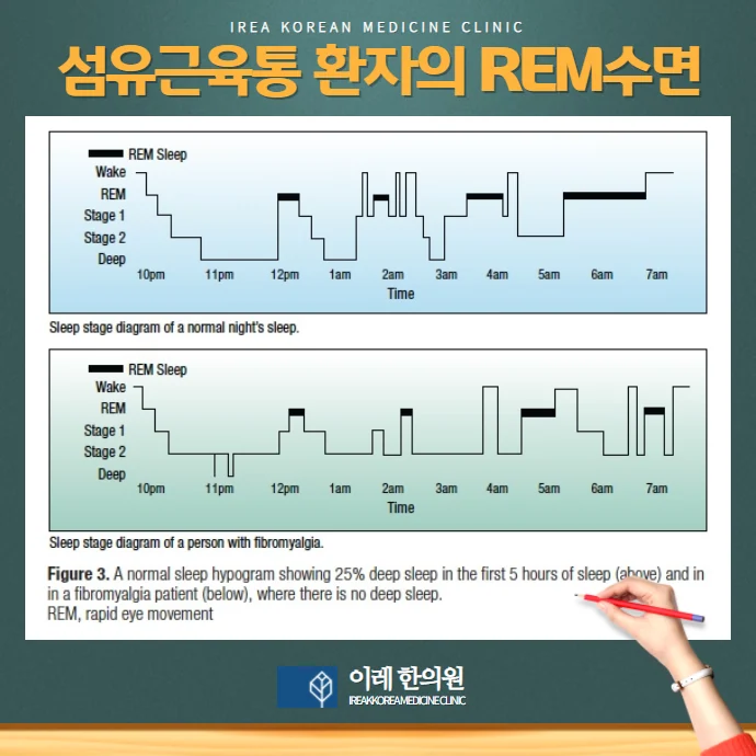 섬유근육통, 불면증과 수면장애도 주요 증상 #2