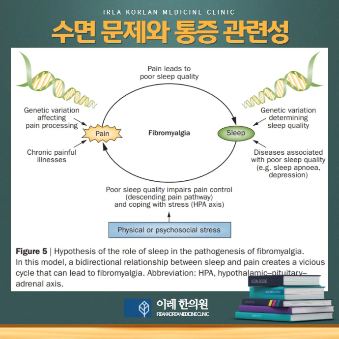 섬유근육통, 불면증과 수면장애도 주요 증상 #3
