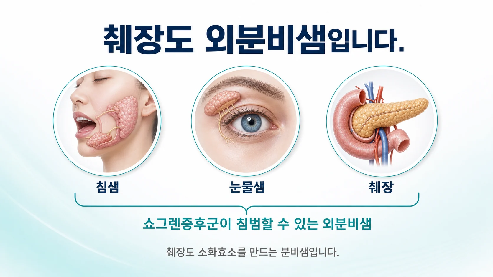 쇼그렌이 침샘 눈물샘뿐 아니라 소화효소를 만드는 외분비샘인 췌장도 침범할 수 있음을 설명하는 이미지
