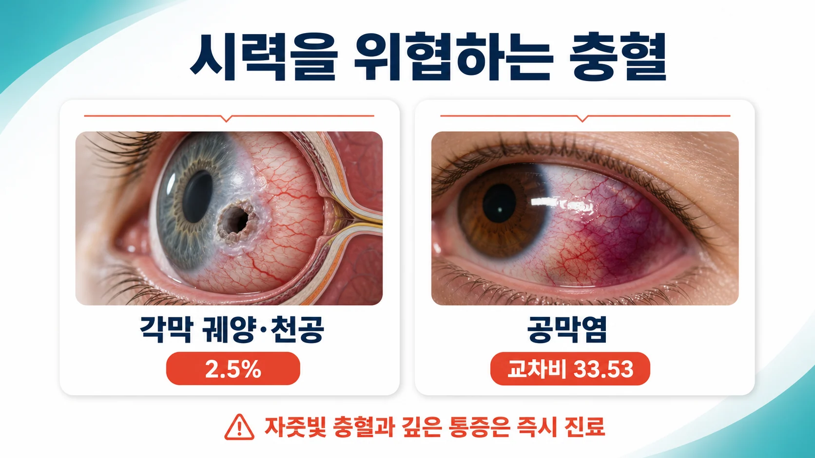 쇼그렌증후군에서 각막 궤양 천공 공막염 등 시력을 위협하는 충혈의 원인을 정리한 이미지