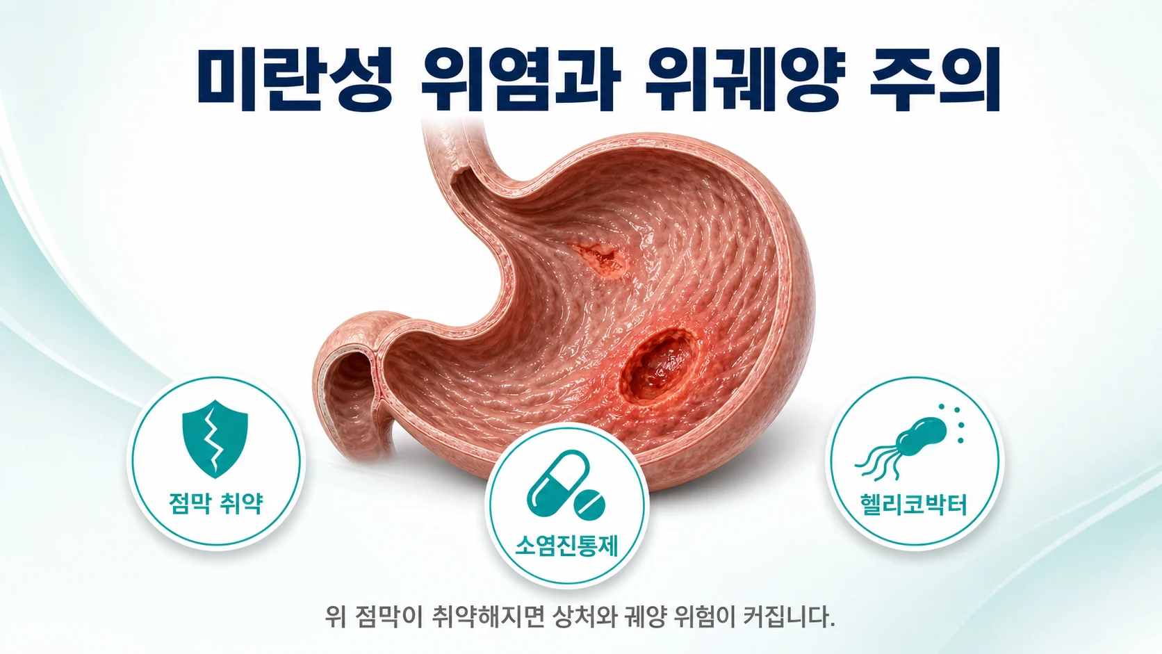 위 점막 취약성과 소염진통제 헬리코박터 감염이 미란성 위염과 위궤양의 위험을 높이는 요인을 정리한 이미지