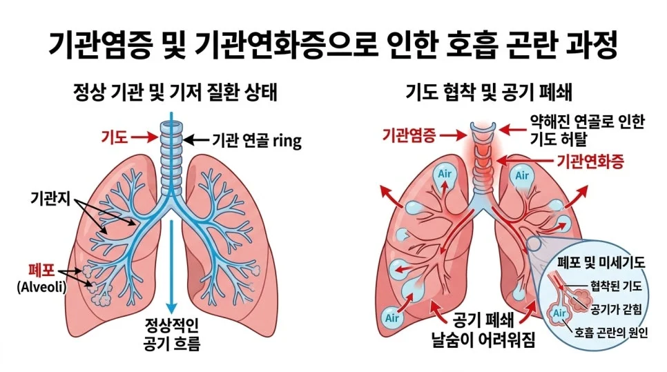 기관 CT 소견