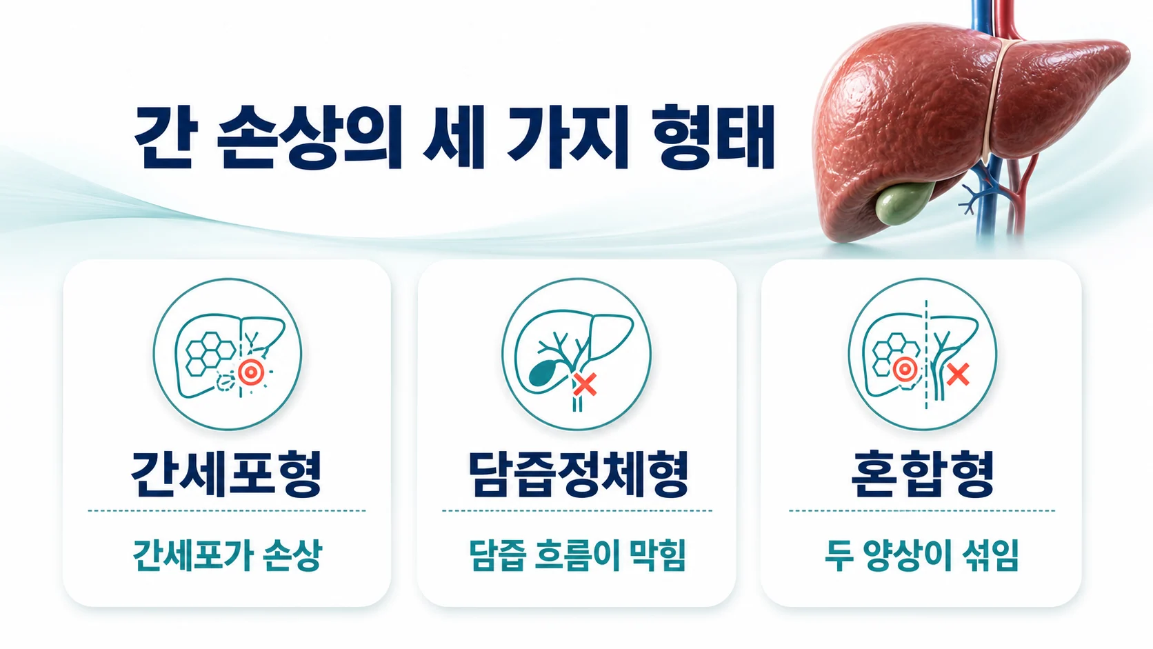 스타틴에 의한 간 손상의 세 가지 형태를 간세포형 담즙정체형 혼합형으로 나누어 보여 주는 그림