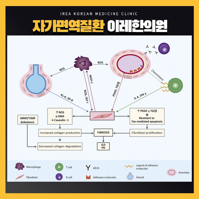전신경화증 관련 폐증상 간질성폐렴과 폐동맥 고혈압 #3