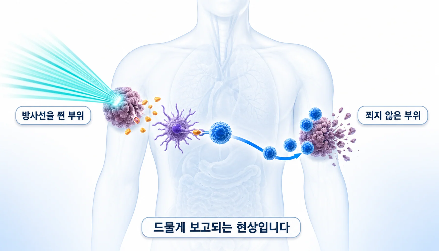방사선 뒤 항원이 드러나 다른 부위 종양까지 줄어드는 원격 효과를 그린 그림