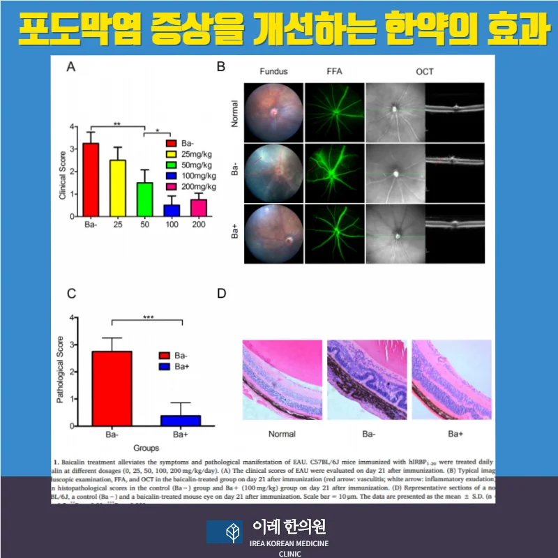 포도막염, 자가면역 질환과 관련될 수 있습니다 #5