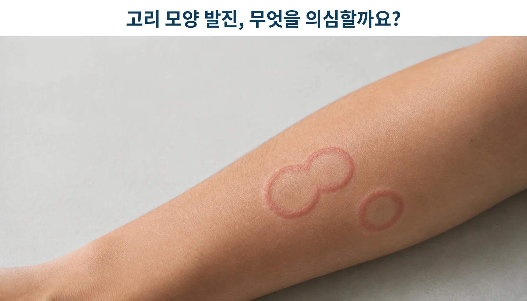 고리 모양으로 번지는 붉은 발진을 촬영한 사진