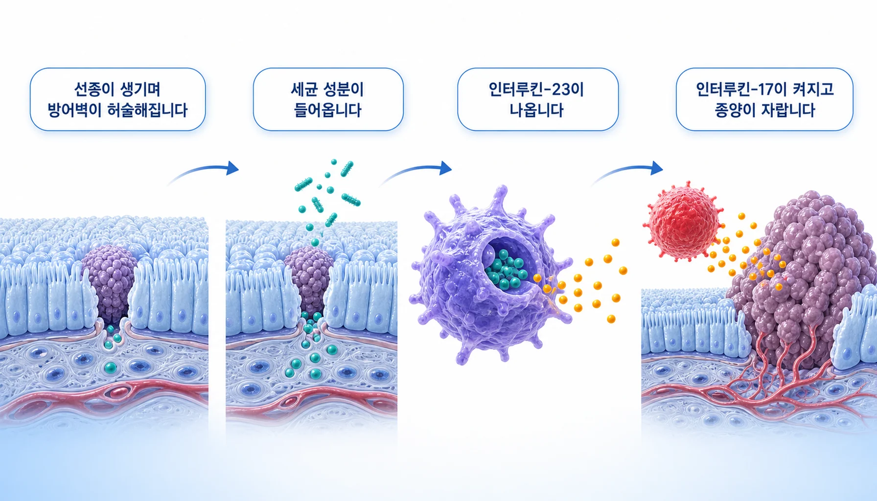 장 점막의 방어벽이 허물어져 세균 성분이 들어오고 인터루킨-17이 켜지는 과정을 그린 그림