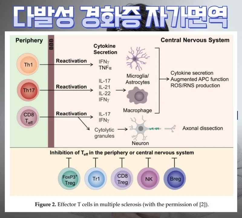 다발성 경화증 종류와 예후는 #2