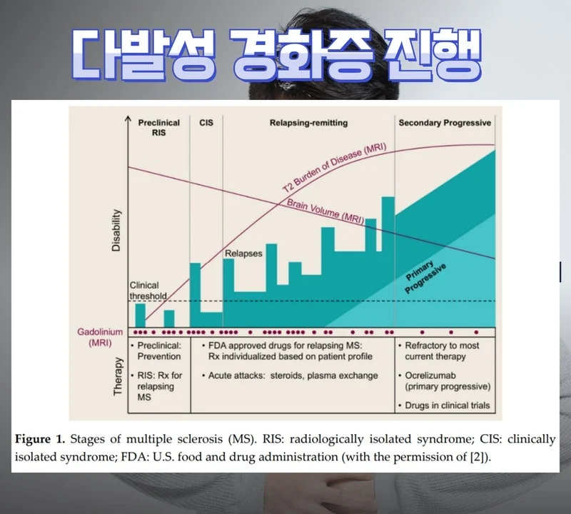 다발성 경화증 종류와 예후는 #3