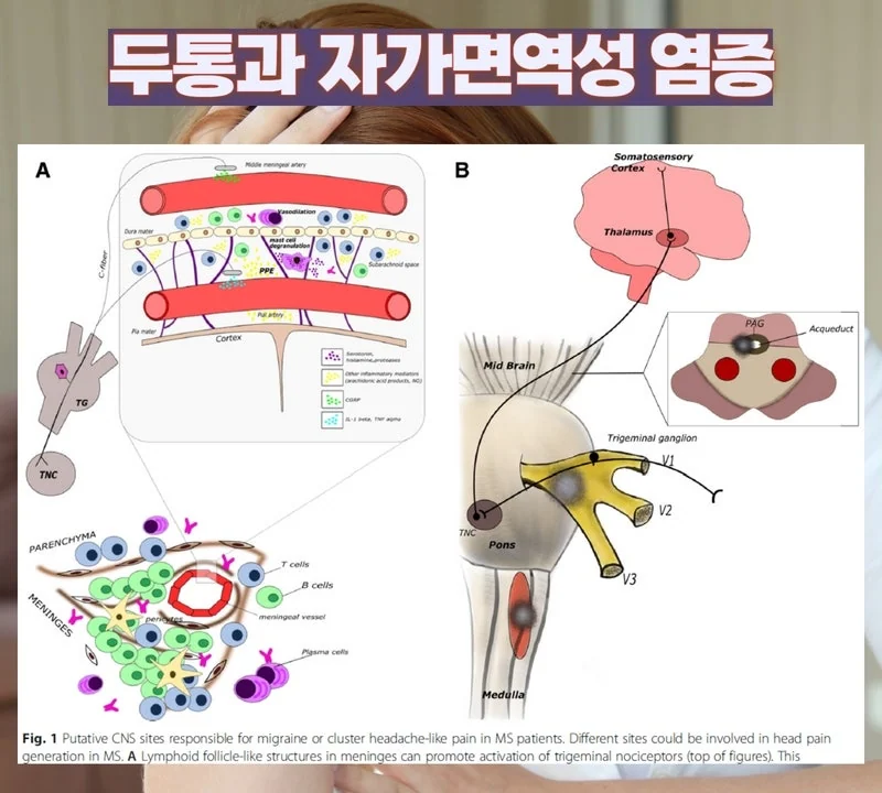 두통, 편두통은 자가면역질환의 주요 증상 중 한 가지 #3