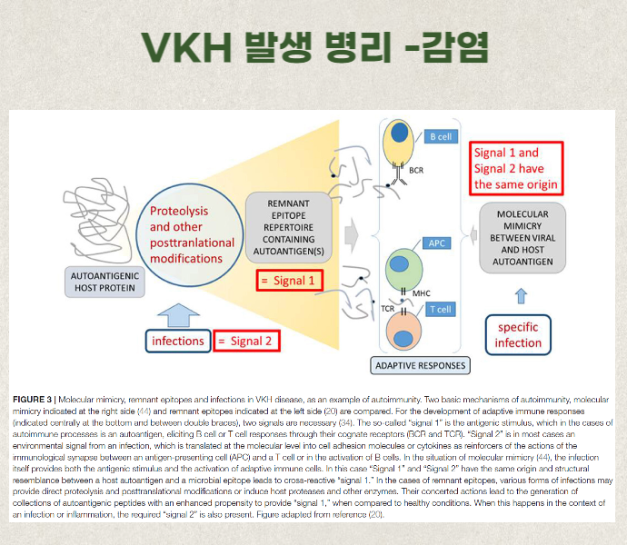 보그트 고야나기 하라다 병VKH : 녹내장 발병 위 #3