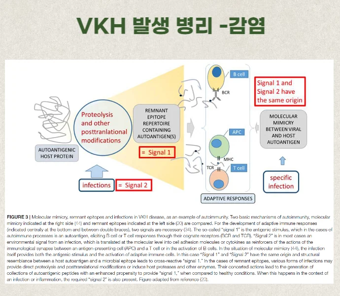 보그트 고야나기 하라다 병VKH : 녹내장 발병 위 #3