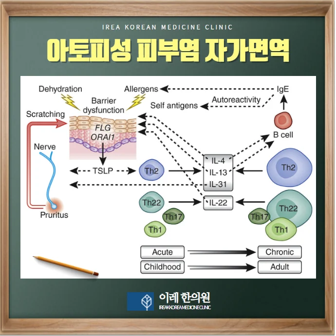 아토피성 피부염과 자가면역질환과의 관련성 ANA 양성인 #3