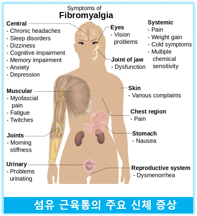 섬유근육통 진단 기준의 변화를 설명하는 이미지