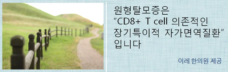 원형탈모의 만성 재발성 특성을 설명하는 이미지