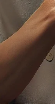 장미색 비강진과 윤상 홍반 그리고 두드러기 차이점 #23