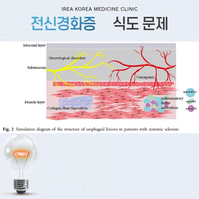 전신경화증 경피증 #3