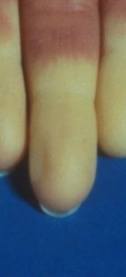 전신경화증 증상 진단 나이별 차이와 사망률 #30