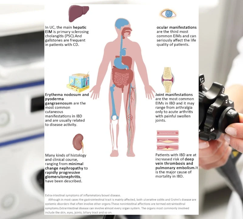 크론병Crohns disease, CD 진단과 I #2