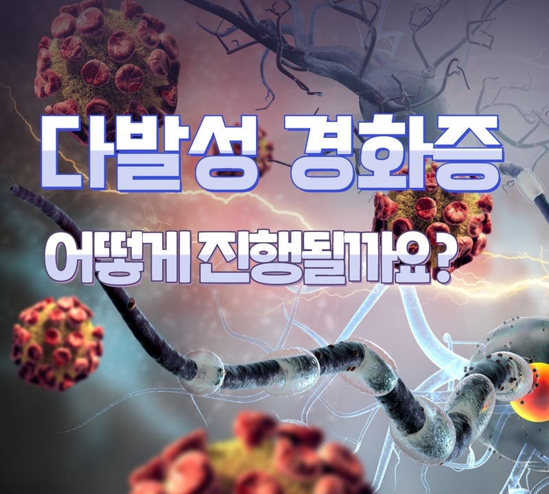 다발성 경화증 종류와 예후는