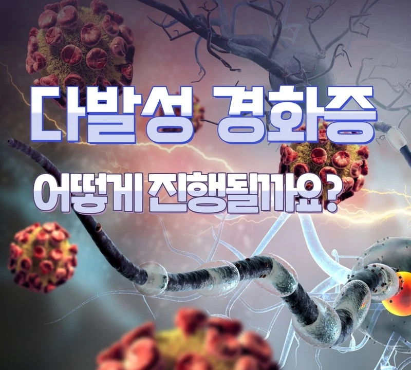 다발성 경화증 종류와 예후는