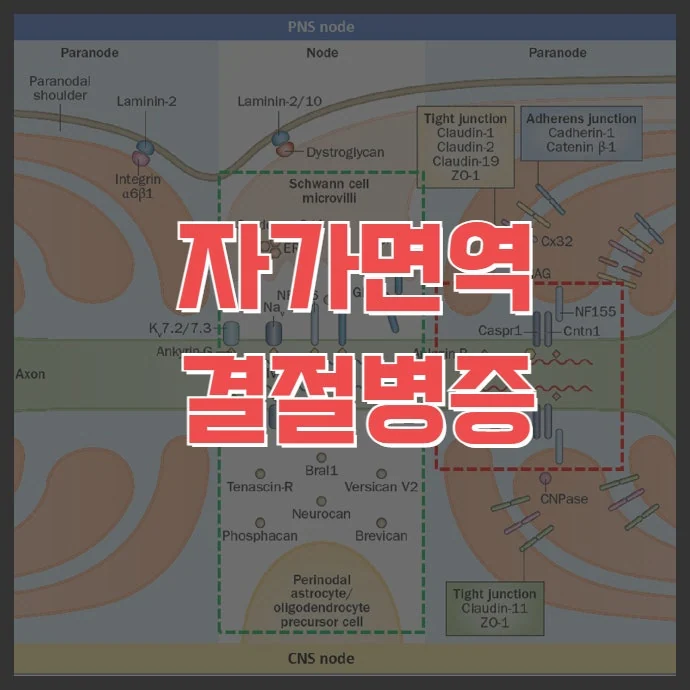 자가면역 결절병증 (autoimmune nodopathy)