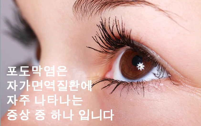 자가면역성 포도막염의 한의학 치료를 소개하는 인천 이레한의원