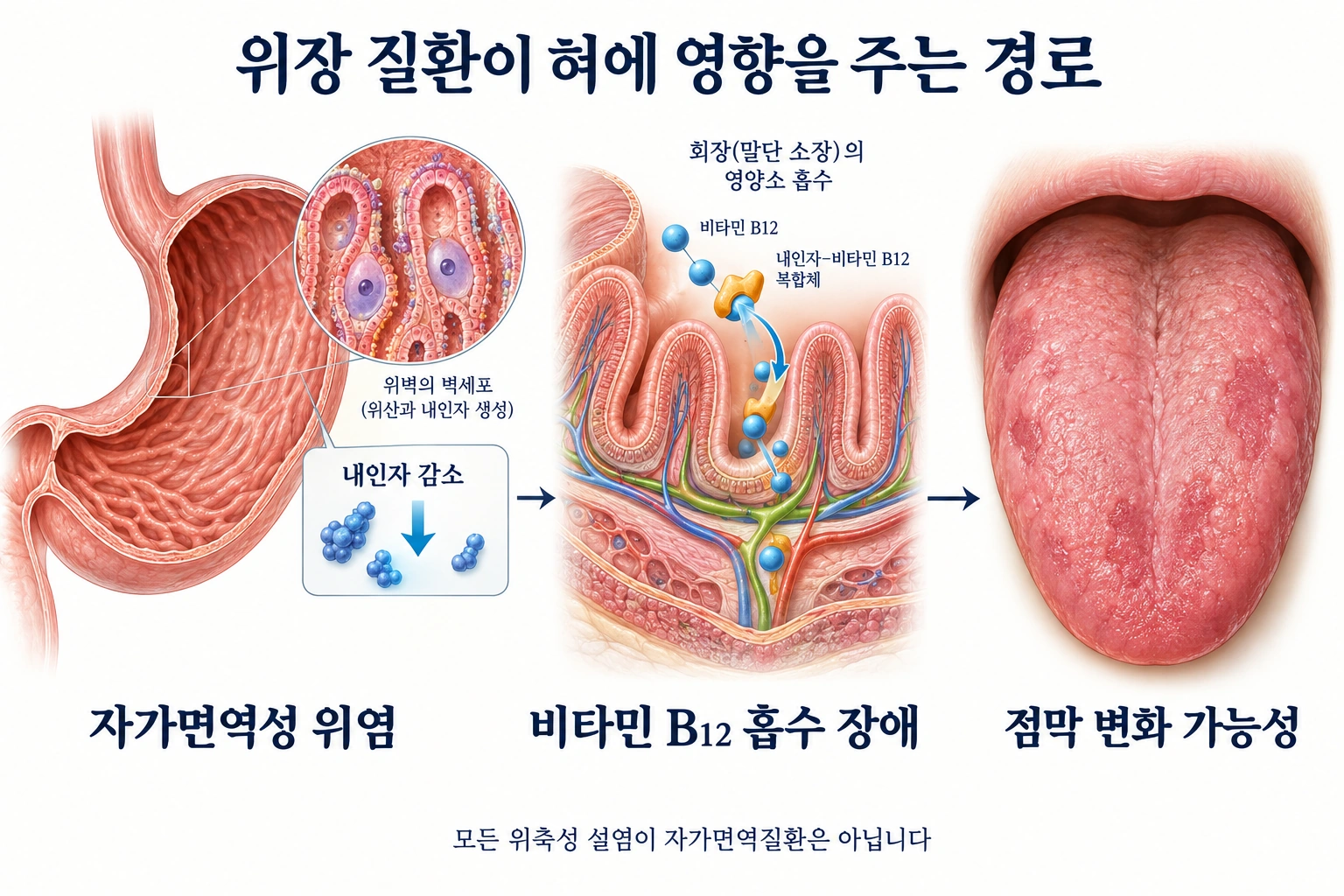 자가면역성 위염의 내인자 감소와 비타민 B12 흡수 장애가 혀 점막 변화로 이어질 수 있는 경로