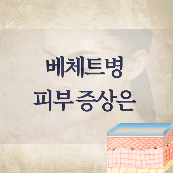 베체트병 증상 - 피부에 나타나는 모낭염 가성모낭염 (여드름 뾰루지)
