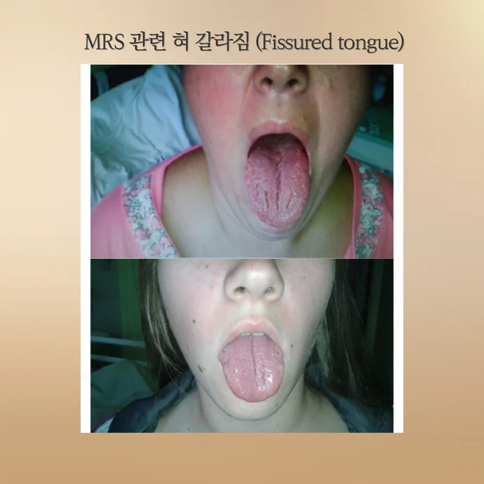 혀가 갈라지는 원인 - 멜커슨-로젠탈 증후군과 자가면역질환의 관계 - img 02