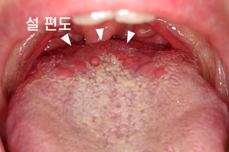 혀 안쪽 돌기와 통증 -- 성곽유두인지 BMS인지 구분하는 법 - img 02