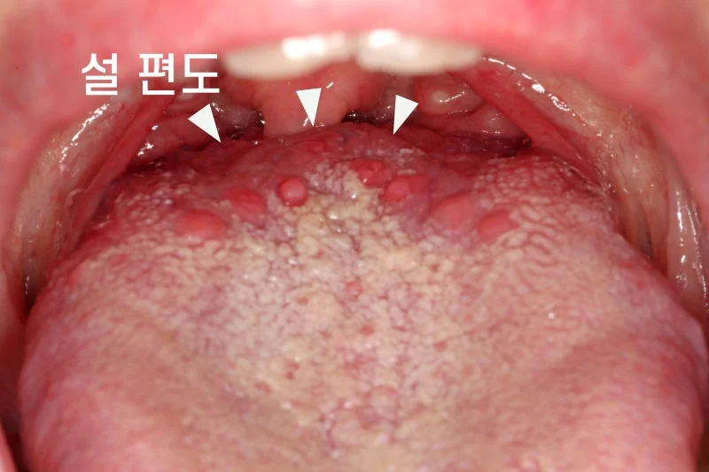 혀 안쪽 돌기와 통증 -- 성곽유두인지 BMS인지 구분하는 법 - img 02