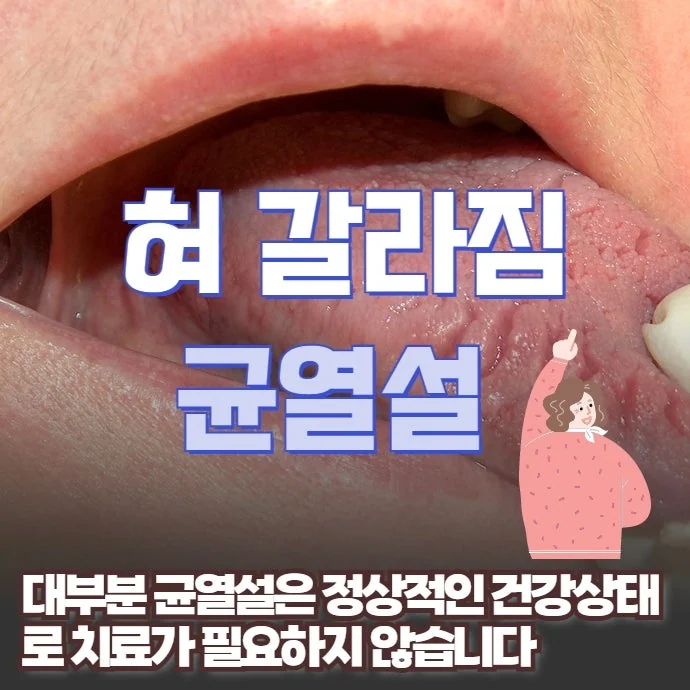 혀 갈라짐(균열설)은 치료가 필요 없는 정상 상태 — 관련 질환과 주의사항