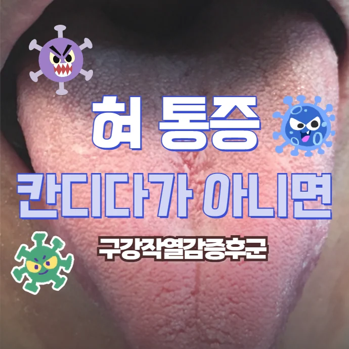 혀 통증, 칸디다균 때문이 아니라면 구강작열감증후군을 의심하세요