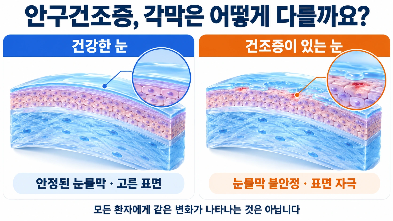 안구건조증, 눈이 계속 따갑고 흐릴 때 각막은 어떨까요?