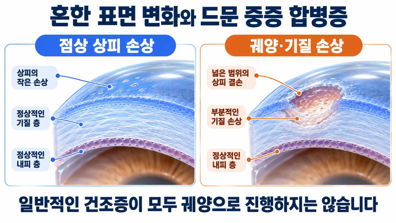 작은 점상 상피 손상과 기질까지 영향을 받는 각막궤양을 구분한 모식도