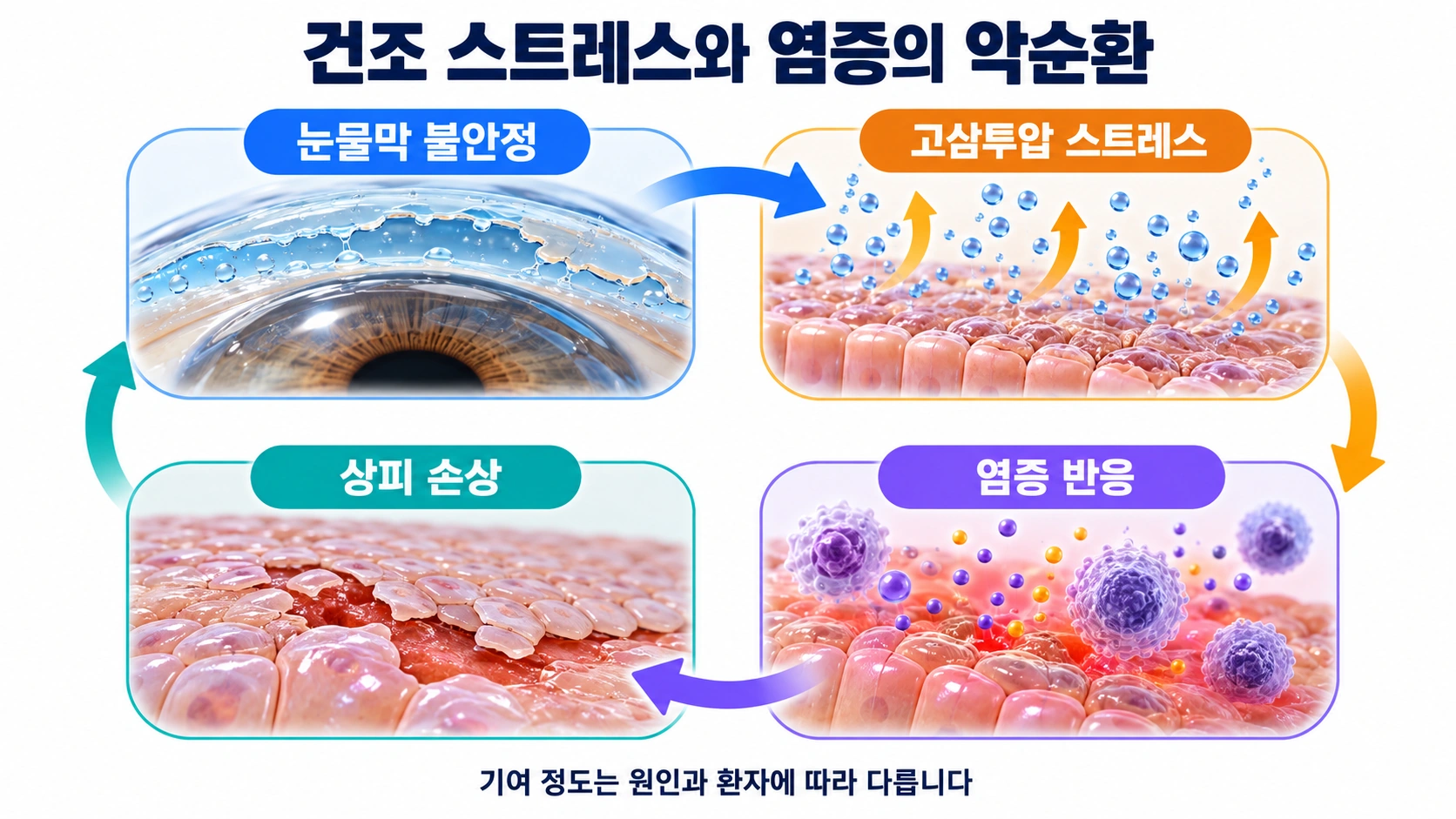 눈물막 불안정, 고삼투압 스트레스, 염증 반응, 상피 손상이 서로 영향을 주는 과정을 설명한 모식도