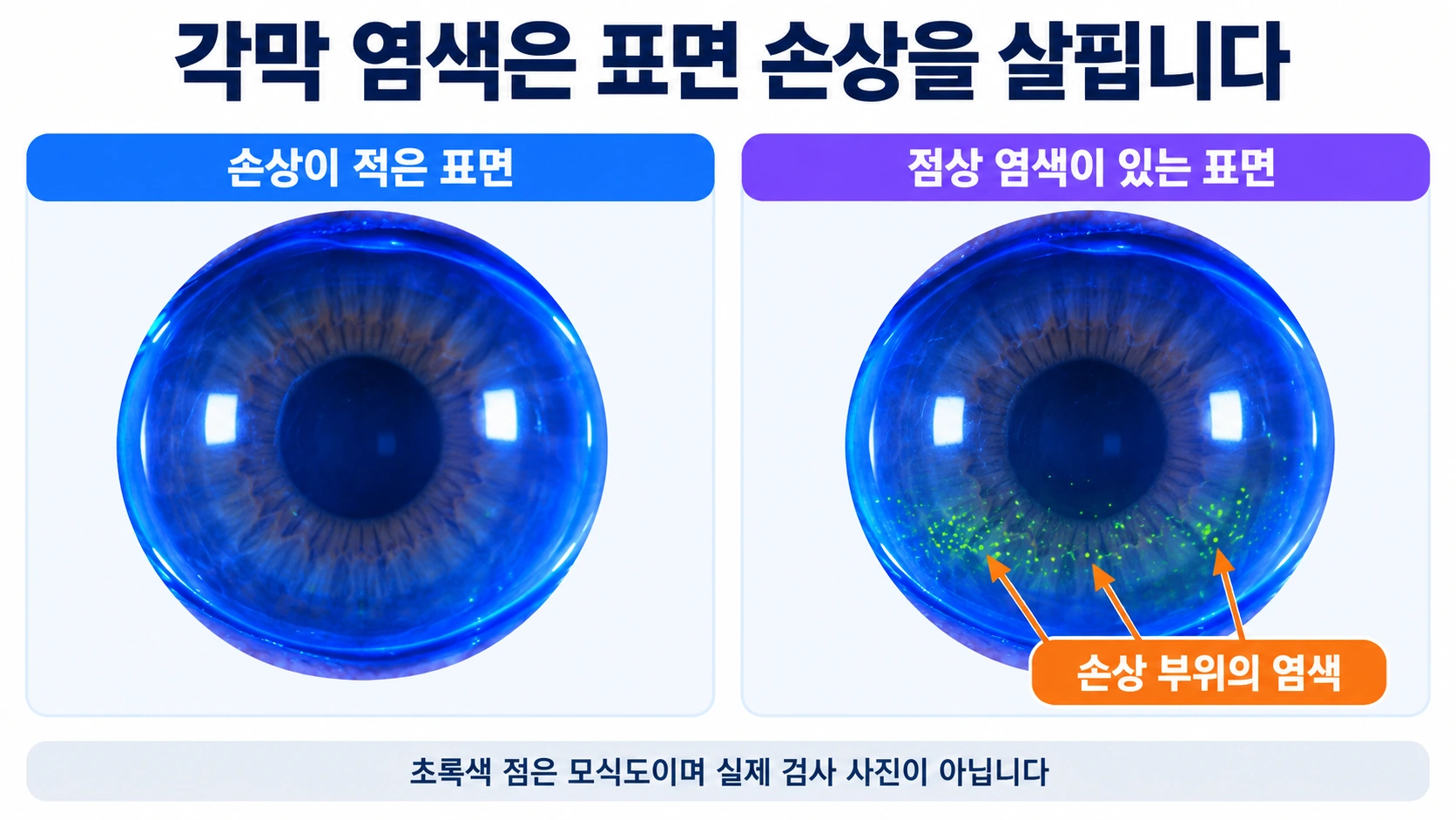 손상이 적은 각막과 아래쪽에 점상 염색이 보이는 각막을 비교한 교육용 모식도
