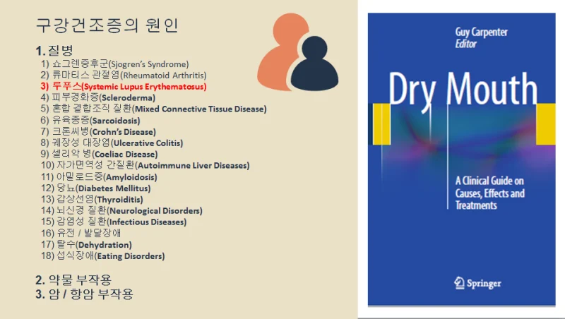 구강건조증의 원인, 루푸스 — 환자의 75%가 구강 증상을 경험합니다