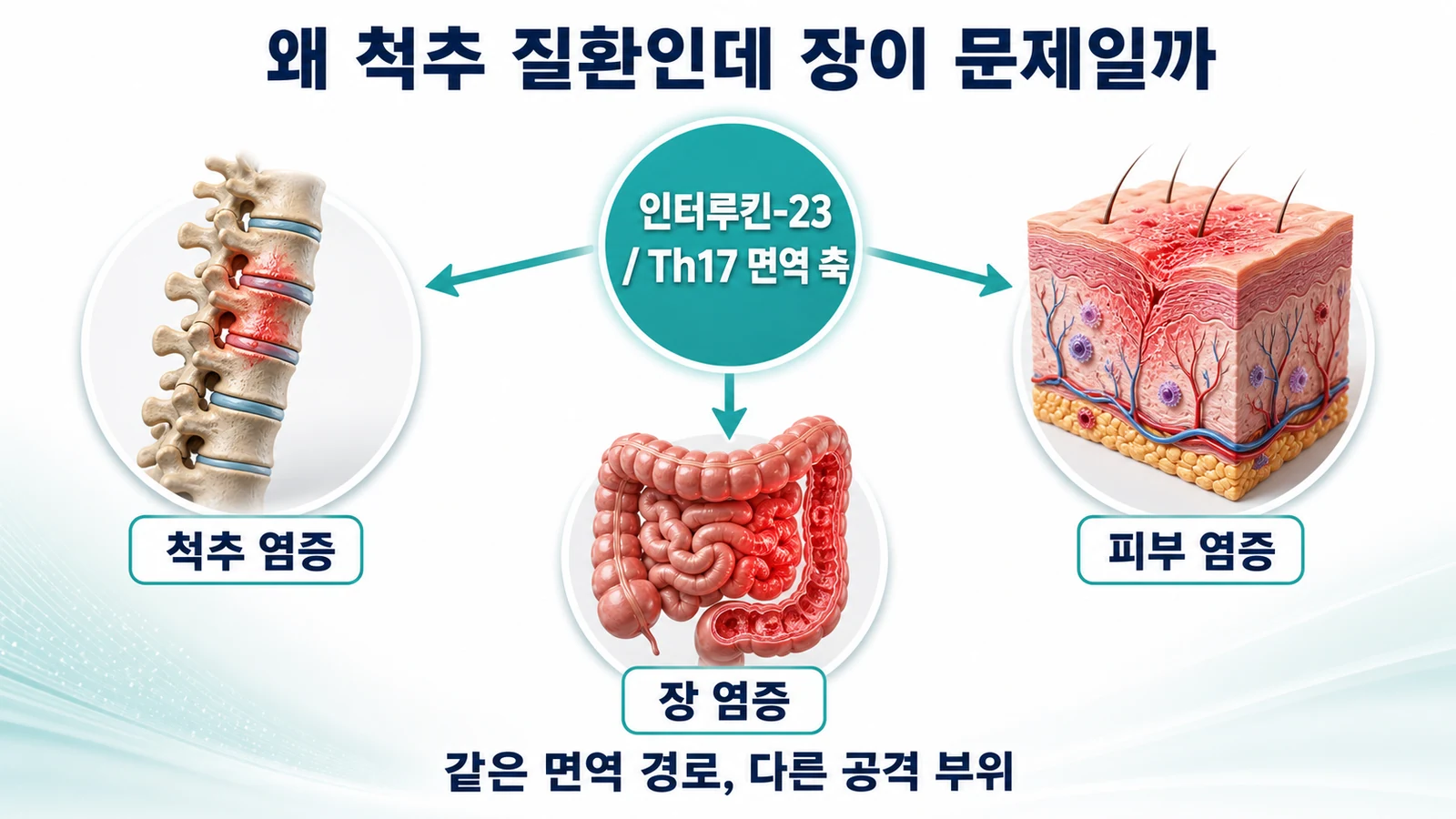 인터루킨-23과 Th17 면역 축을 공유하지만 공격 부위가 다르다는 것을 설명하는 인포그래픽