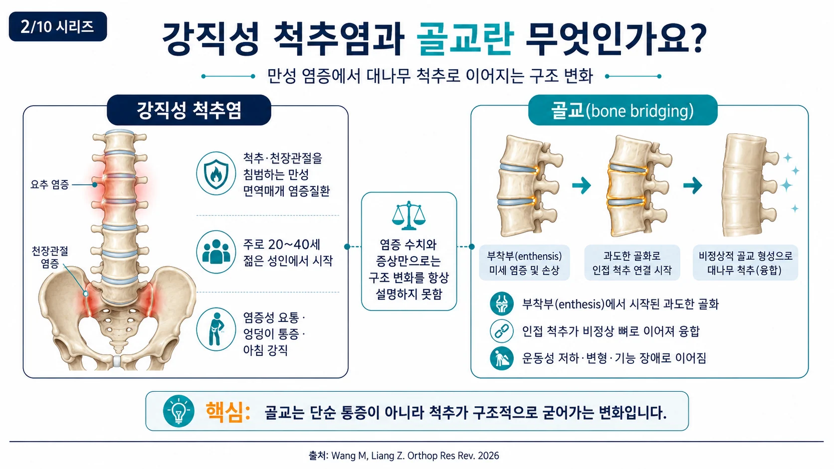 강직성 척추염과 골교란 — 부착부 골화가 척추를 융합