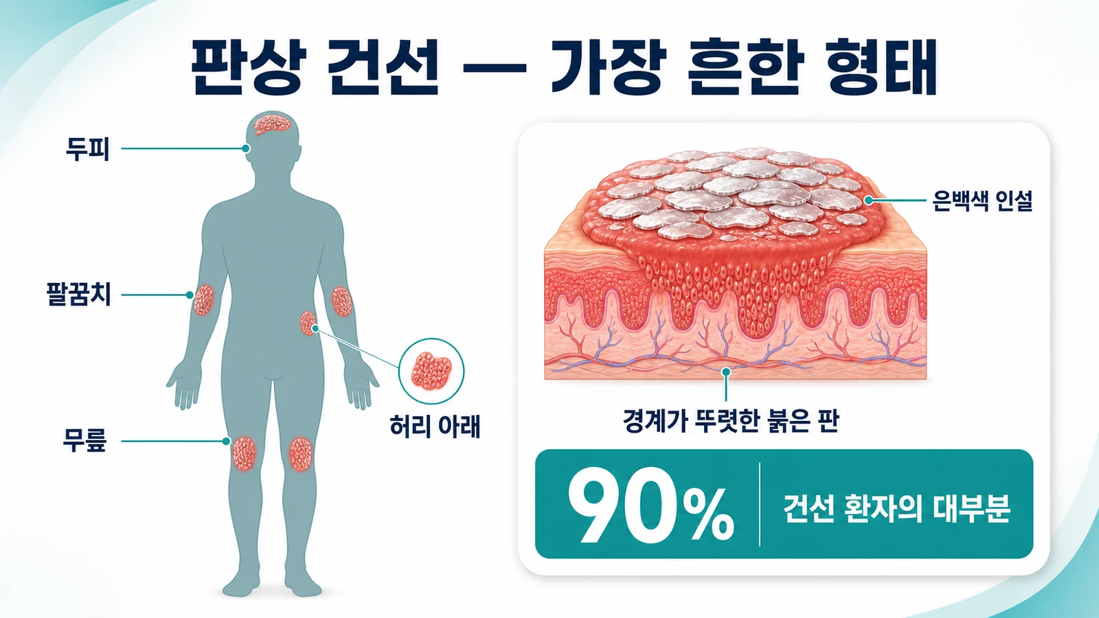 판상 건선이 잘 생기는 부위와 병변 구조