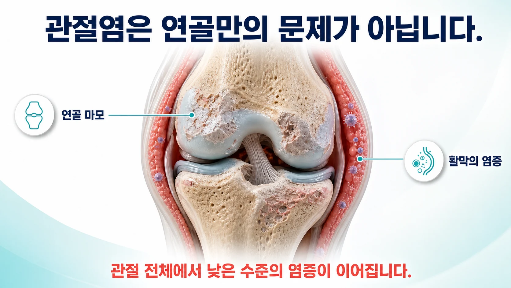 골관절염을 연골 마모만이 아니라 관절 전체의 면역 반응으로 보는 관점을 나타낸 그림