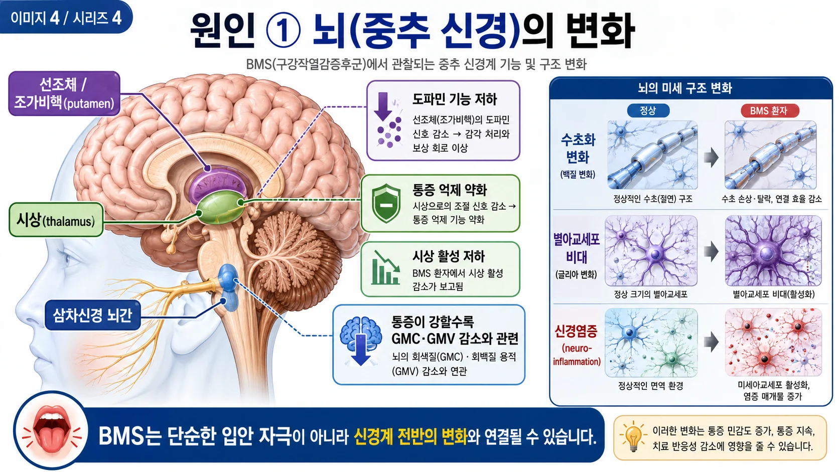 BMS 원인 ① 뇌(중추 신경)의 변화 — 도파민·회백질·신경염증