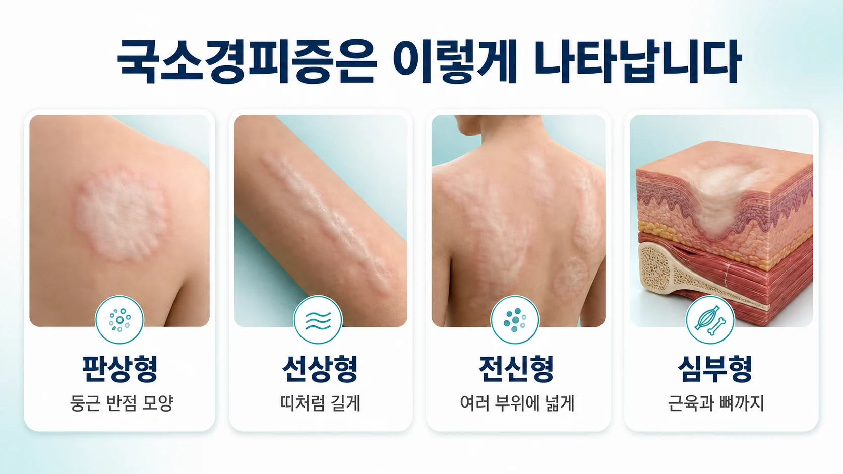 국소경피증의 네 가지 형태를 정리한 도식