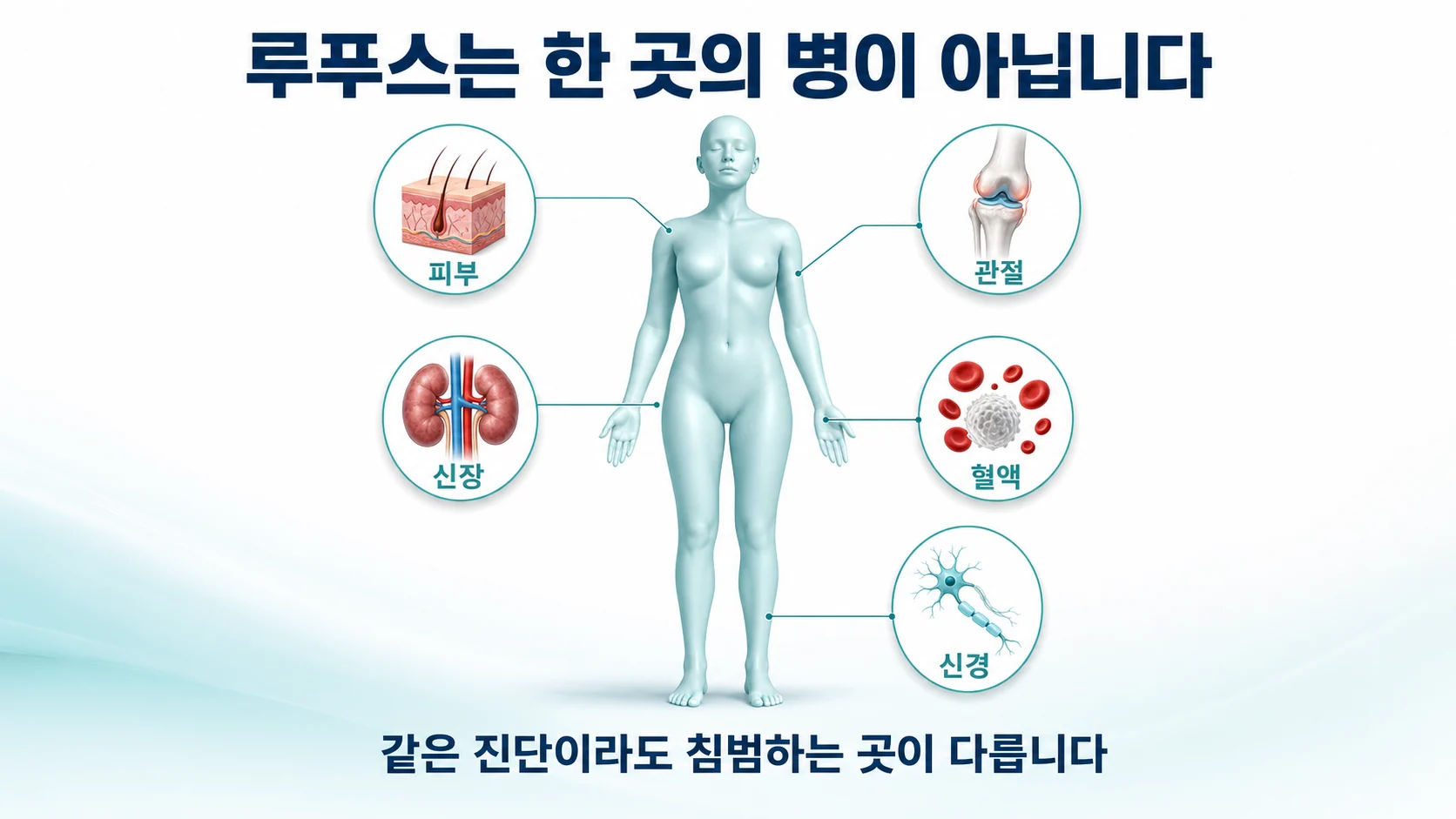 루푸스가 피부, 관절, 신장, 혈액, 신경을 침범할 수 있음을 보여주는 도식